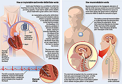 diagram of brain stimulation